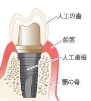 インプラントの構造|清瀬 グリーンタウン歯科